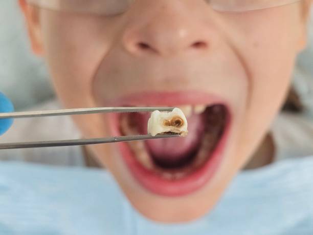 Best Emergency Tooth Extraction in Nyssa, OR